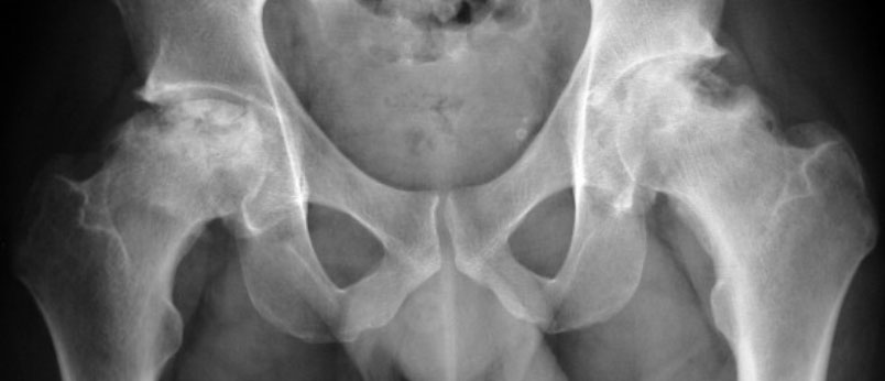 Sport Hip Injuries Sport Hip Injuries