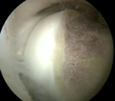 Cam-Resection Hip Arthroscopy