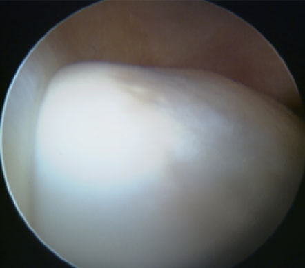 Cam – Hip Arthroscopy