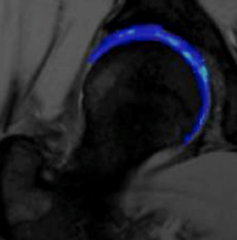 Cartilage Mapping Cartilage Mapping Image