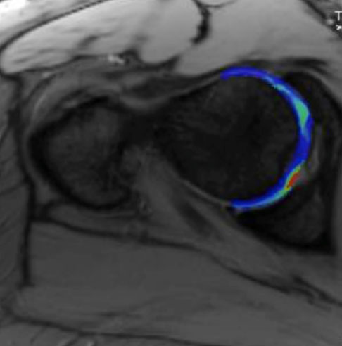 Cartilage Mapping Cartilage Mapping Image