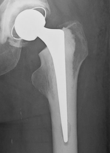 Total Hip Replacement London Total Hip Replacement London