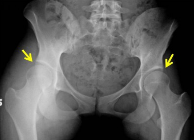Sport Hip Injuries Sport Hip Injuries