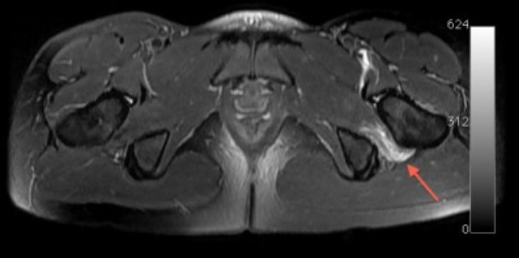 EXTRA-ARTICULAR-IMPINGEMENT–giles-stafford-Consultant-orthopaedic-hip-surgeon