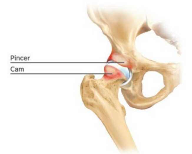 Sport Hip Injuries Sport Hip Injuries