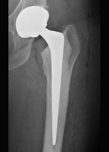 Total Hip Replacement London Total Hip Replacement London