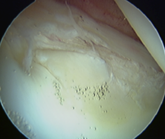 LABRAL TEARS-giles-stafford