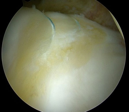 Labral-Repair – Hip Arthroscopy