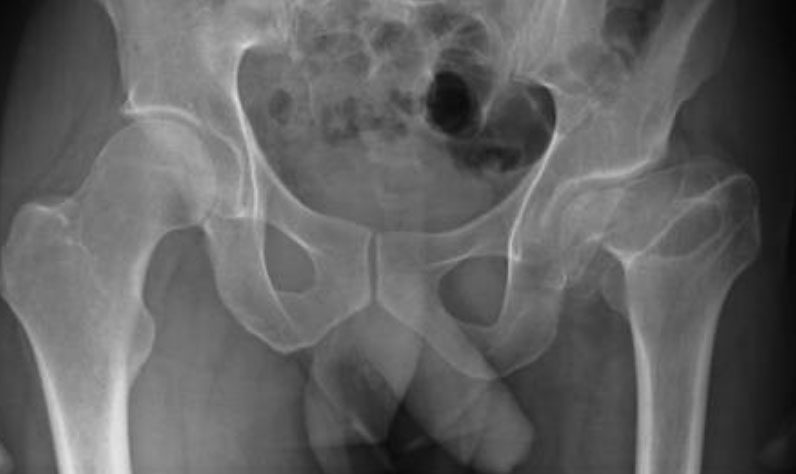 Sport Hip Injuries Sport Hip Injuries
