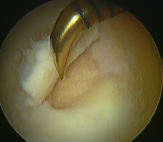 STEM CELL THERAPY – Hip Arthroscopy