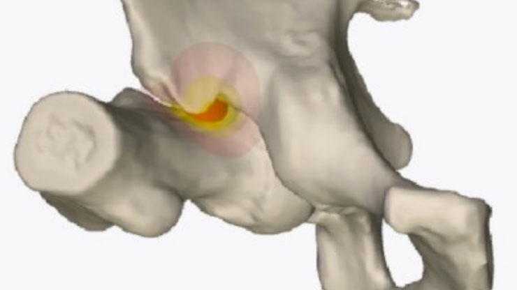 SUBSPINE-IMPINGEMENT-giles-stafford-Consultant-orthopaedic-hip-surgeon