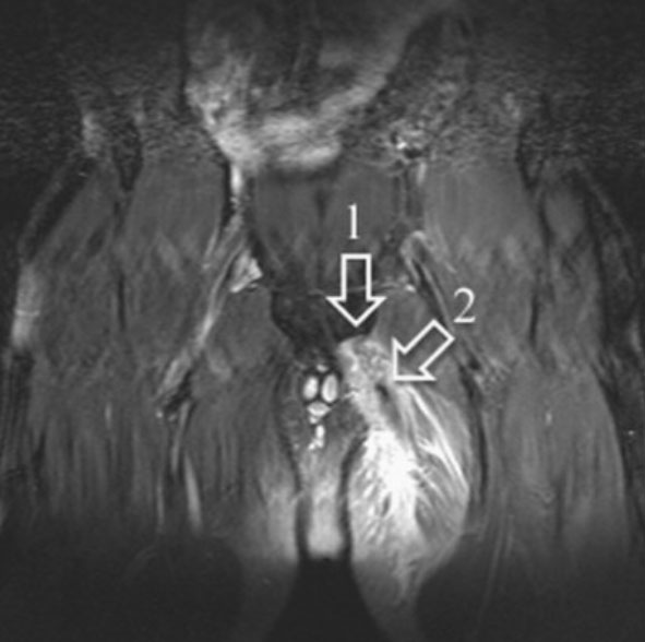 Sport Hip Injuries