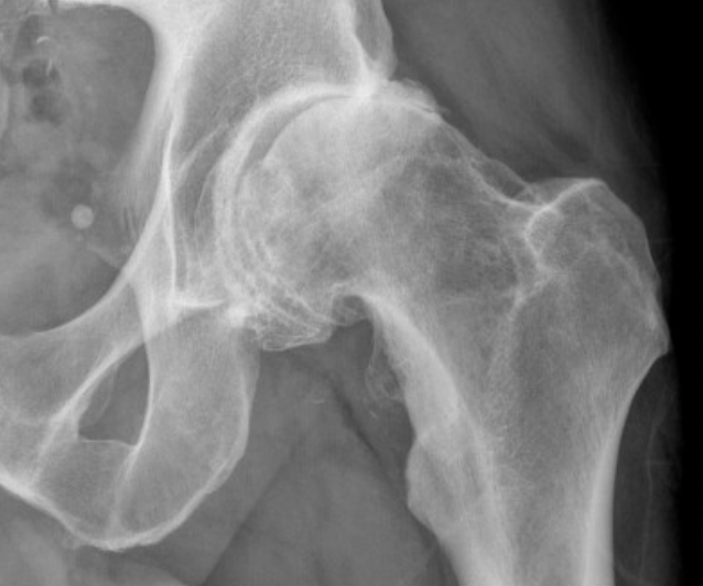 Sport Hip Injuries Sport Hip Injuries