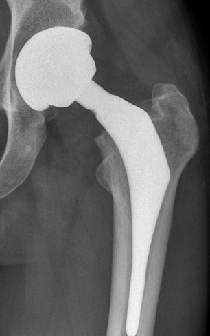 Custon-Hip -Total Hip Replacement London Custon-Hip Xray
