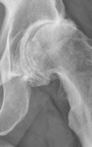 Sport Hip Injuries Sport Hip Injuries