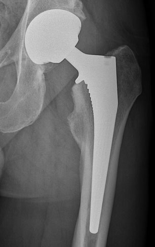 Metafix – Total Hip Replacement London Total Hip Replacement London
