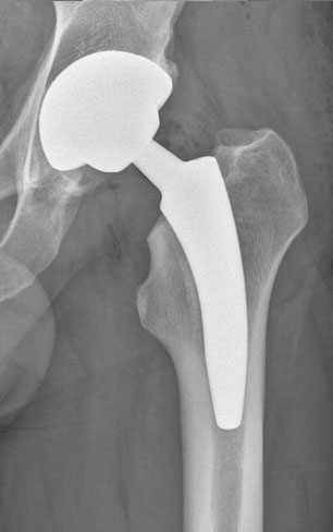 Mini-Hip – Total Hip Replacement London Total Hip Replacement London