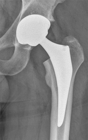Trifit – Total Hip Replacement London Total Hip Replacement London